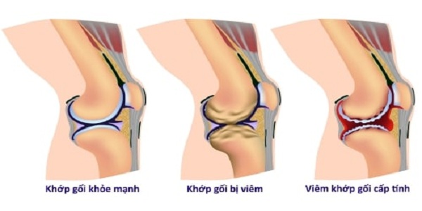 viem khop goi 